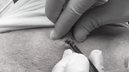 La doctora Lee saca un punto negro ENORME Dra Sandra Lee Especialista en piel Discovery HH_1080p